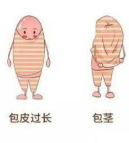 包茎的治疗方法知多少？达州南方医院来解答